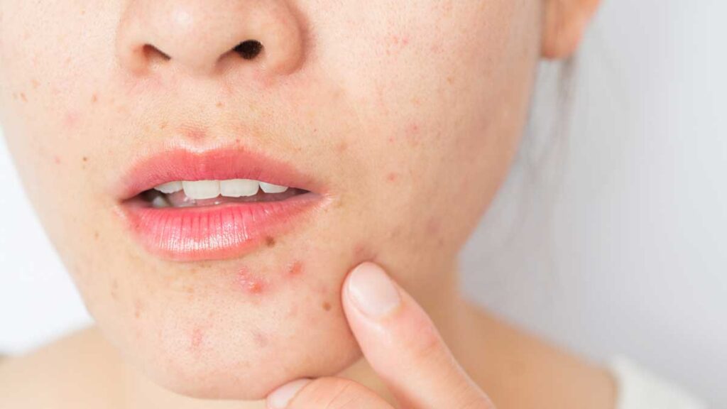 pimples on face