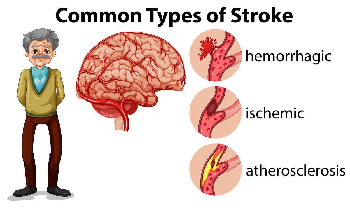 Types to stroke 
